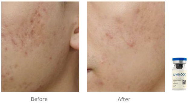 분당 여드름흉터치료 - 쥬베룩볼륨