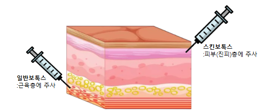 분당 모공개선 - 스킨보톡스