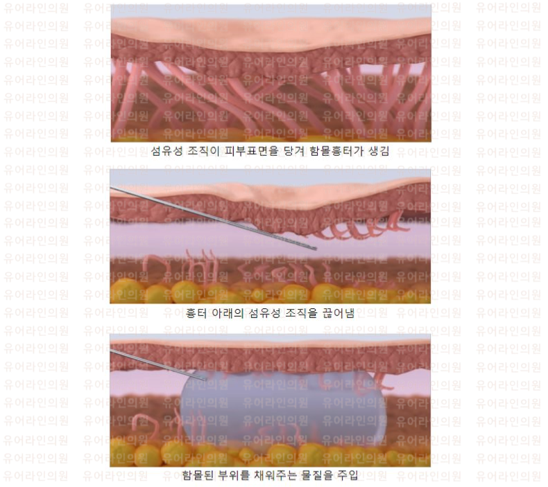 분당 여드름흉터치료 - 서브시전