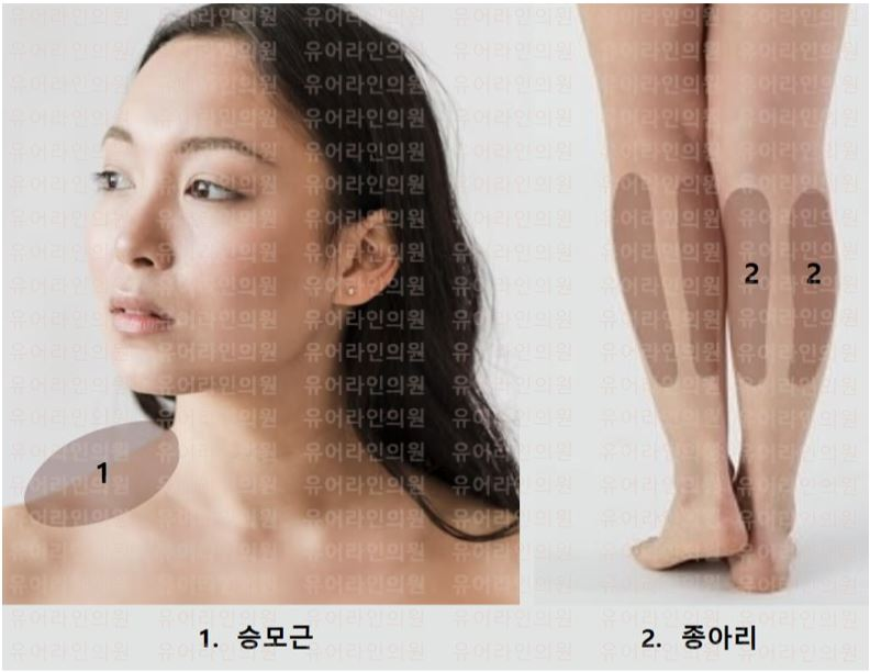 분당 승모근 · 종아리 보톡스