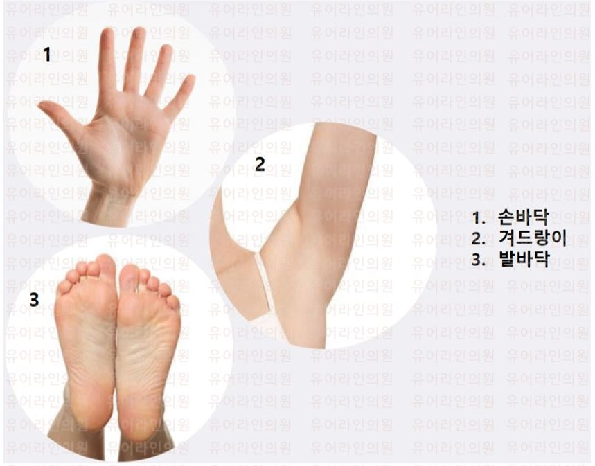 분당 다한증 보톡스