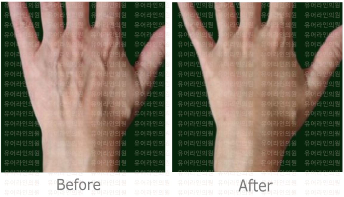 분당 손 지방이식