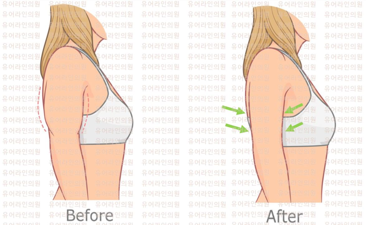 분당 팔 지방흡입 · 지방추출주사