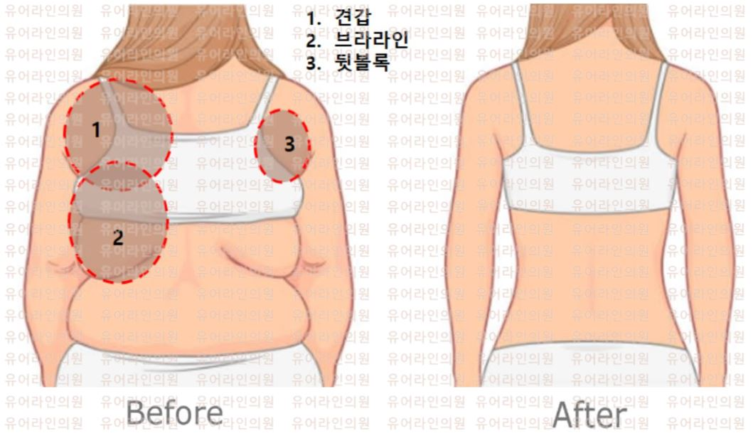 분당 등 (견갑 · 브라라인 · 뒷볼록) 지방흡입 · 지방추출주사