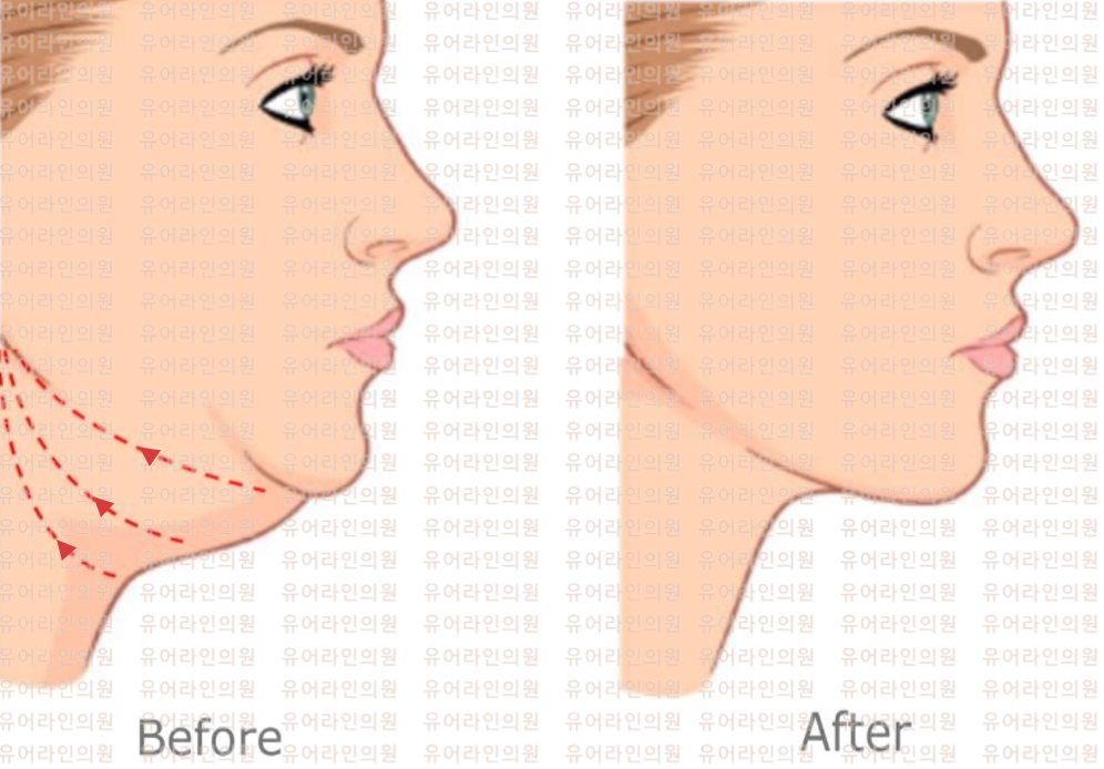 분당 이중턱 실리프팅
