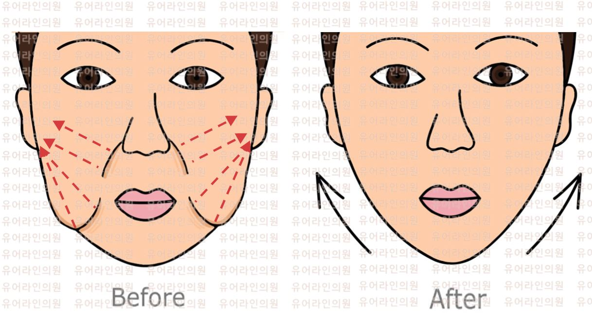 분당 팔자주름 · 심부볼 실리프팅