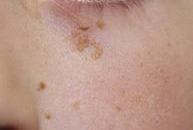 편평사마귀(편사) 레이저 제거 (개수 무제한, 듀오덤 없이)