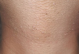 편평사마귀(편사) 레이저 제거 (개수 무제한, 듀오덤 없이)